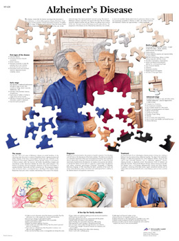 Wandkaart: Alzheimers Disease