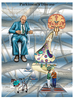 Wandkaart: Parkinsons Disease